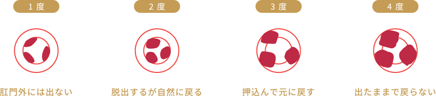 痔核(イボ痔)